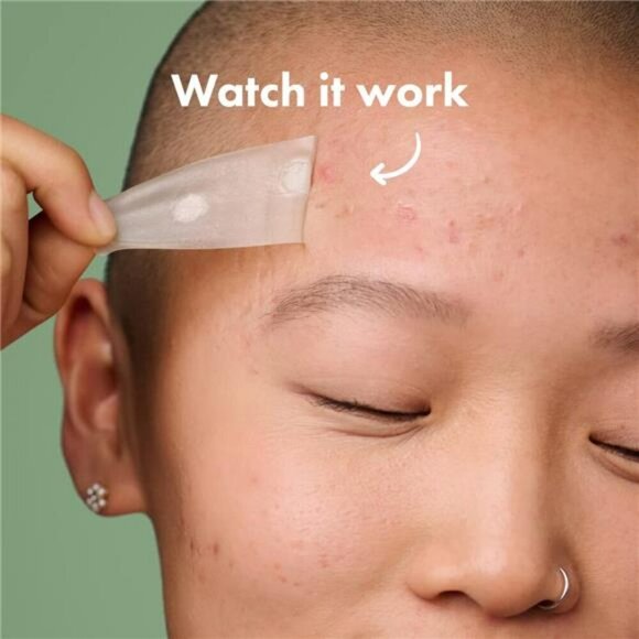 Mighty Patch Surface Acne Pimple Patch for Face Body Chin Forehead 10 Count - Picture 4 of 7